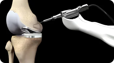 Robotic partial knee replacement